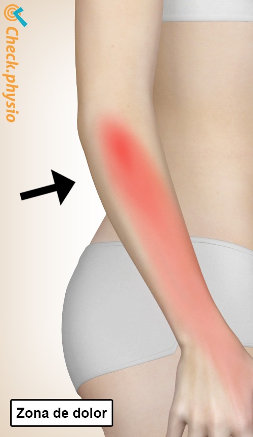 brazo síndrome del túnel radial ubicación