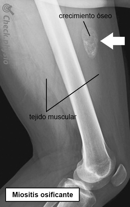 miositis osificante anatomía radiográfica