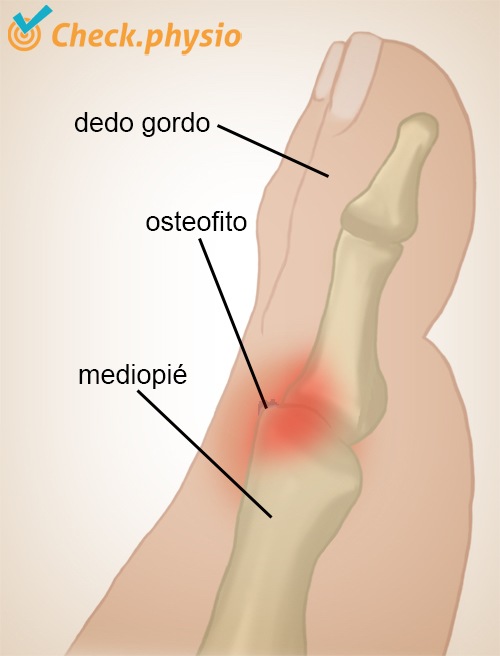 pie formación de osteofitos en el hallux rigidus