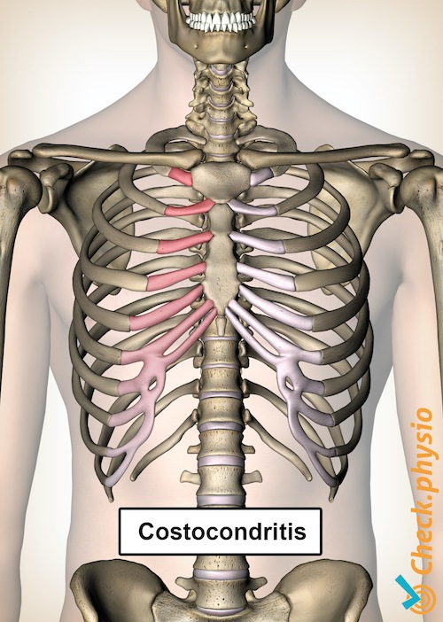 costocondritis costillas dolor pecho esternón